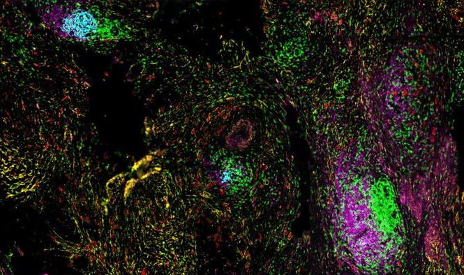 Image: Spatial organization of TLSs within the tumor microenvironment. Image shows TLSs containing T cells (green), B cells (pink), and follicular dendritic cells (cyan), surrounded by tumor cells (red) and stromal cells (yellow) (Photo courtesy of The University of Texas MD Anderson Cancer Center)
