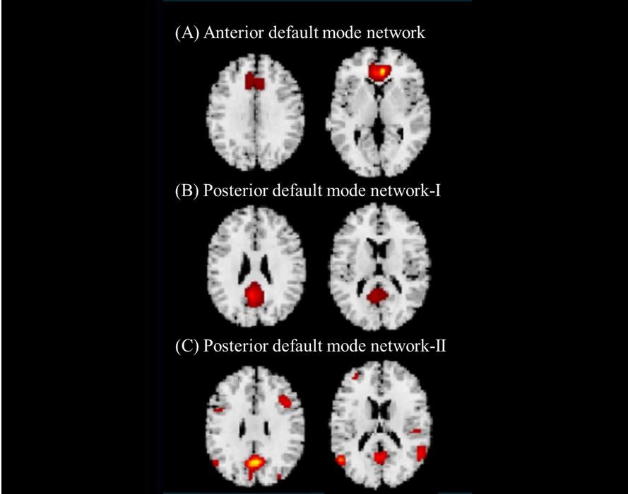 Image: Three gray matter (GM) structural networks related to default mode network (DMN). Three GM structural networks related to DMN that were identified are shown. (A) anterior DMN; (B) posterior DMN-I, including the posterior cingulate cortex (PCC) and precuneus; and (C) posterior DMN-II, including the PCC, precuneus, inferior parietal cortex, and lateral temporal cortices. (Photo courtesy of Nagaya et al., 2026, PLOS One, CC-BY 4.0)