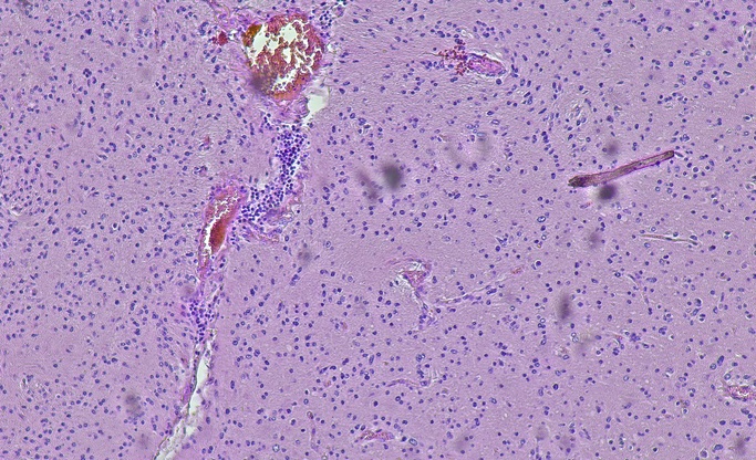 Image: The new AI system classifies 102 molecular subtypes of CNS tumors from digitized, routinely stained histology sections (Image credit: iStock)