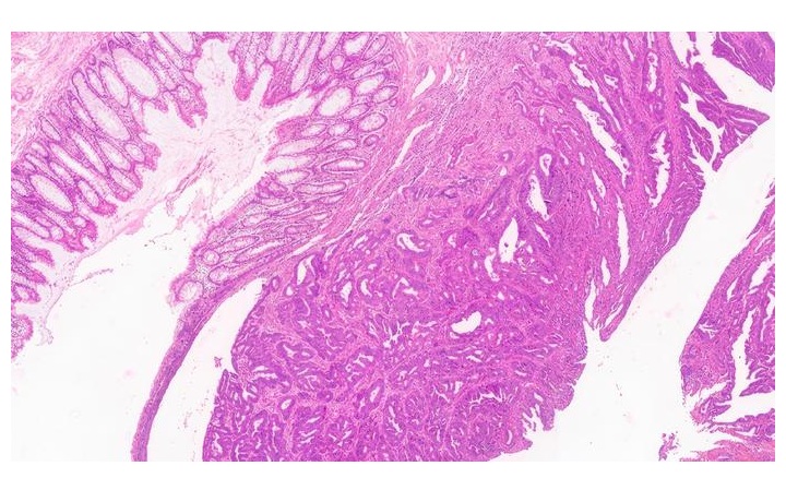 Image: Healthy and cancerous regions in a H&Eble results (Photo courtesy of KAUST)