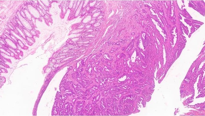 Image: Healthy and cancerous regions in a H&Eble results (Photo courtesy of KAUST)