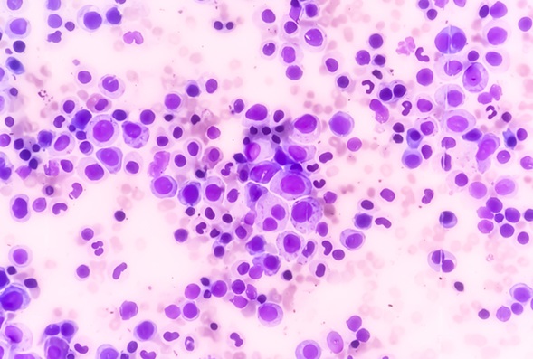 Image: The study offers insight into early development of myeloproliferative neoplasms and may inform tailored monitoring strategies (Image Credit: iStock) Image: The study offers insight into early development of myeloproliferative neoplasms and may inform tailored monitoring strategies (Image Credit: iStock)