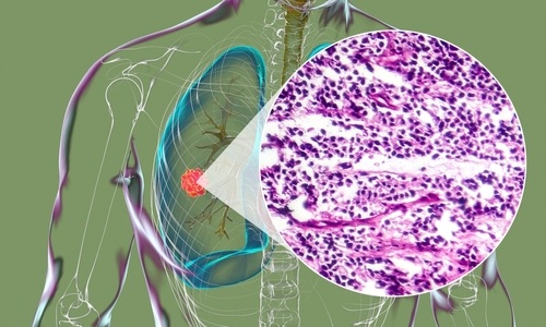 Image: Biomarker testing is critical for lung cancer therapy selection, yet ordering delays mean biopsy-to-result turnaround still averages about 27 days, according to a new study (image credit: Shutterstock)