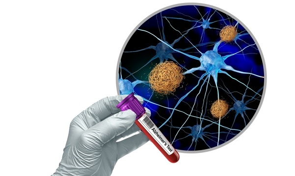 Image: The proposed immunoassay uses ALZpath’s pTau217 antibody to detect Alzheimer’s disease biology in blood, supporting the growing role of blood-based biomarkers in clinical care (Photo courtesy of Shutterstock)