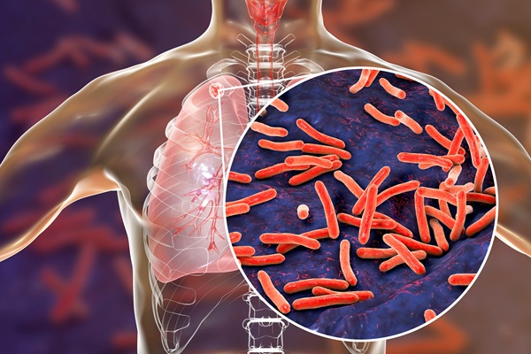 Image: The study identified an unexpected immune signature in active TB, showing that disease is marked not by a weak immune response but by a distinct inflammatory profile (Photo courtesy of Shutterstock)