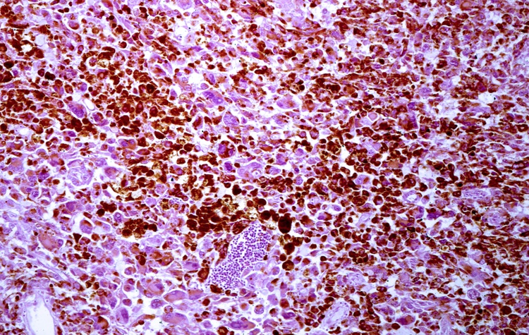 Image: Melanoma staging relies on sentinel lymph node biopsy, but most procedures are negative, highlighting the need for tools that better estimate lymph node involvement and avoid unnecessary surgery (Image credit: Adobe Stock)