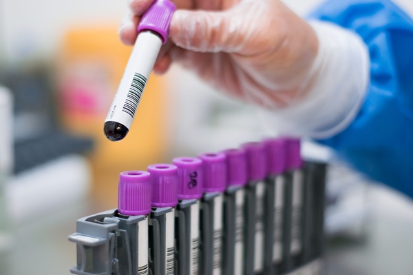Image: A new study shows that an ultrasensitive blood test can detect immune signaling patterns associated with Sjögren’s disease more than a decade before diagnosis (Image Credit: 123RF) Image: A new study shows that an ultrasensitive blood test can detect immune signaling patterns associated with Sjögren’s disease more than a decade before diagnosis (Image Credit: 123RF)