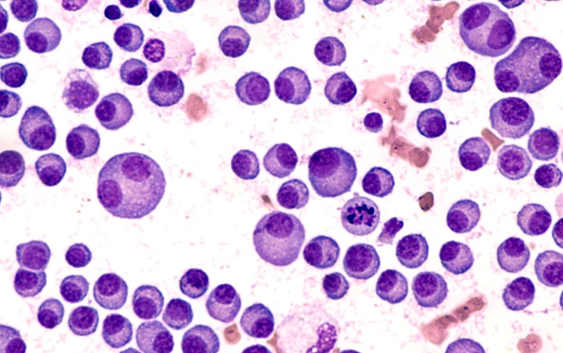 Image: Despite treatment advances, most multiple myeloma patients relapse and identifying high-risk cases at diagnosis remains challenging (Image Credit: Adobe Stock)