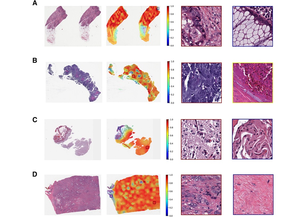 Image: The fine-tuned model predicted seven outputs using whole slide images (WSIs). (Abadh K. Chaurasia et al, The American Journal of Pathology (2026). DOI: 10.1016/j.ajpath.2026.05.008)