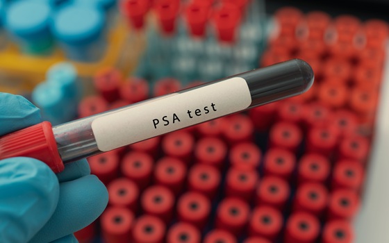 Image: Researchers developed three mathematical biomarkers from routine PSA blood tests that may help predict early prostate cancer treatment outcomes and personalize adaptive therapy (Image Credit: Adobe Stock)