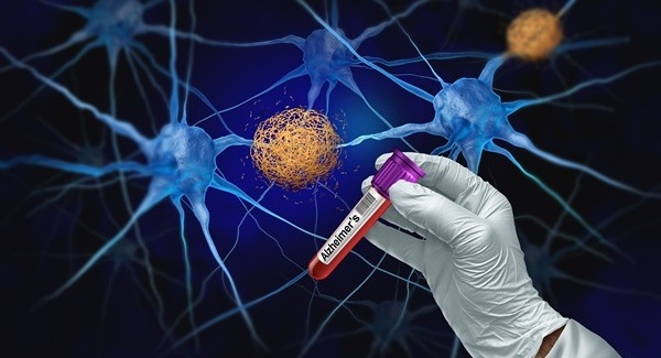 Image: The findings support integrating high-performing plasma p-tau217 assays into Alzheimer’s diagnostic workflows, provided that platform-specific calibration and standardized testing protocols are in place. (Image Credit: Adobe Stock)