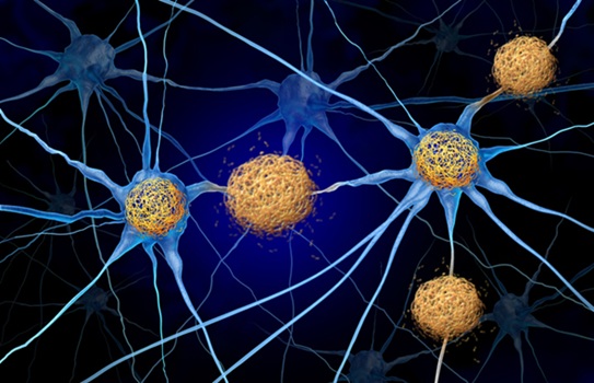 Image: Elecsys pTau217 offers a minimally invasive option for assessing amyloid pathology in adults aged 55 and older with cognitive decline, showing high agreement with amyloid PET imaging (Image Credit: iStock)