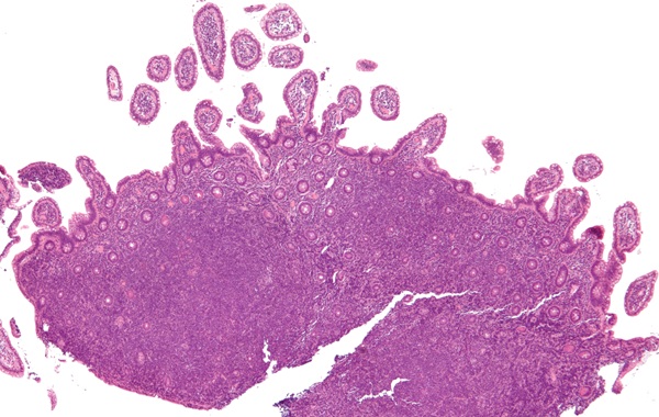 Image: Low magnification micrograph of mantle cell lymphoma of the terminal ileum (Image Credit: Nephron/Wikimedia Commons, CC BY-SA 3.0)