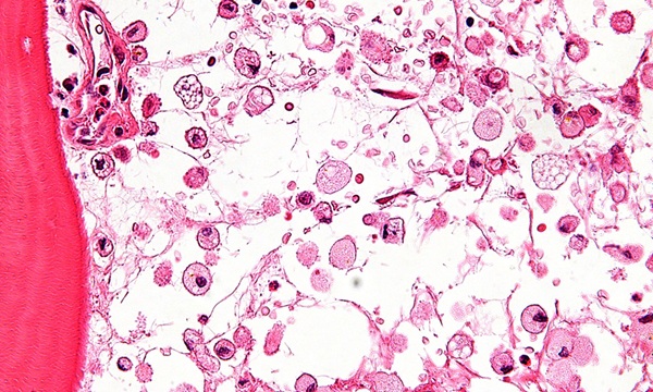 Image: A very high magnification micrograph of Gaucher disease, a lysosomal disorder (Image Credit: Nephron/Wikimedia Commons, CC BY-SA 3.0)