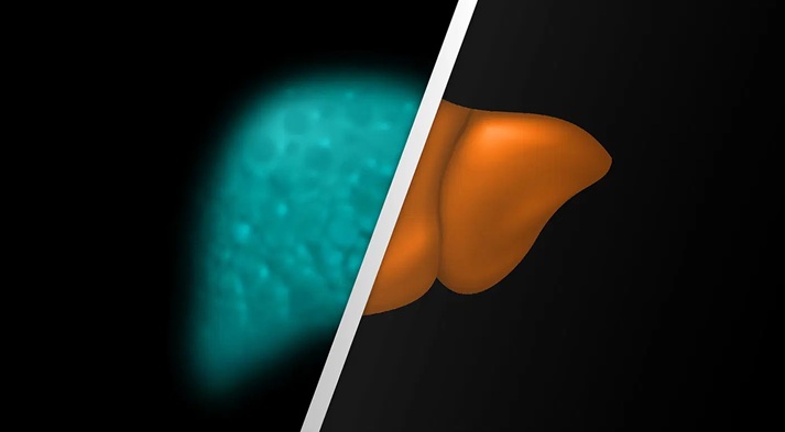 Image: Central to the collaboration is the Enhanced Liver Fibrosis (ELF) test, a noninvasive blood test authorized in the U.S. to assess disease progression risk in patients with advanced fibrosis due to MASH and support patient management decisions. (Photo courtesy of Siemens Healthineers)