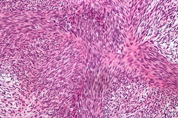 Image: MPNST is a cancer of the connective tissue surrounding peripheral nerves, with NF1 being a key risk factor (Image Credit: Nephron/Wikimedia Commons (CC BY-SA 3.0)
