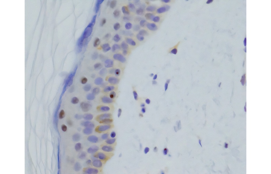 Image: Skin samples from people with a suspected genetic myopathy were examined for confirmation of disease. Brown spots show abnormal protein buildup inside the nuclei of cells (purple), typical of a type of myopathy called oculopharyngodistal myopathy. (Image Credit: Garvan Institute)