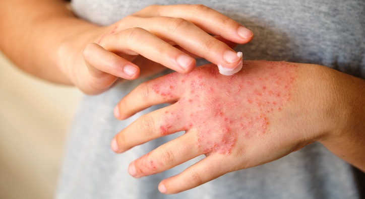 Image: Many patients with atopic dermatitis modify systemic therapy because of inadequate efficacy, highlighting the need for molecular tools and biomarkers to guide treatment selection. (Image Credit: iStock)