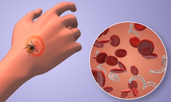 Image:  A new single-tier diagnostic test now demonstrates potential to improve early detection by analyzing antibody responses to Borrelia burgdorferi antigens (Image Credit: Shutterstock)