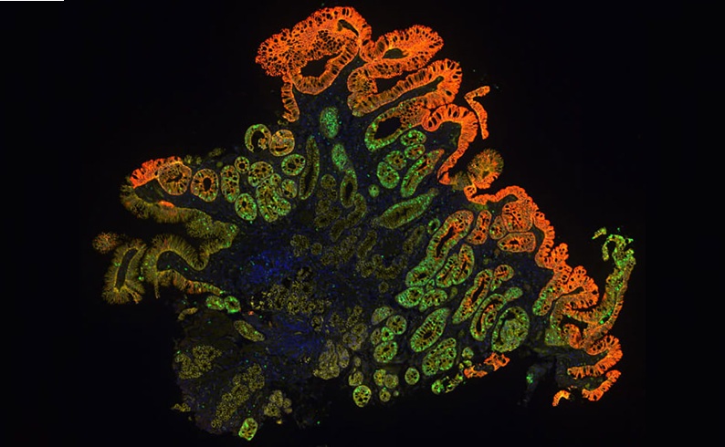Image: TissueCypher analyzes protein biomarkers and tissue architecture in biopsy samples to estimate five-year risk of progression to high-grade dysplasia or esophageal adenocarcinoma. (Photo courtesy of Castle Biosciences)
