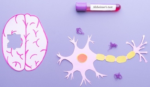 Image: The test identifies individuals more likely to have elevated brain amyloid, with PET used for confirmation (Image Credit: Adobe Stock)