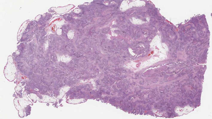 Image: Ovarian cancer tissue image. (Photo courtesy of Heba Sailem/King\'s College London)