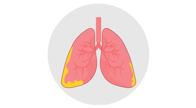 Image: The automated IHC assay helps identify mesothelioma and distinguish it from other malignancies, including NSCLC. (Image Credit: Shutterstock)