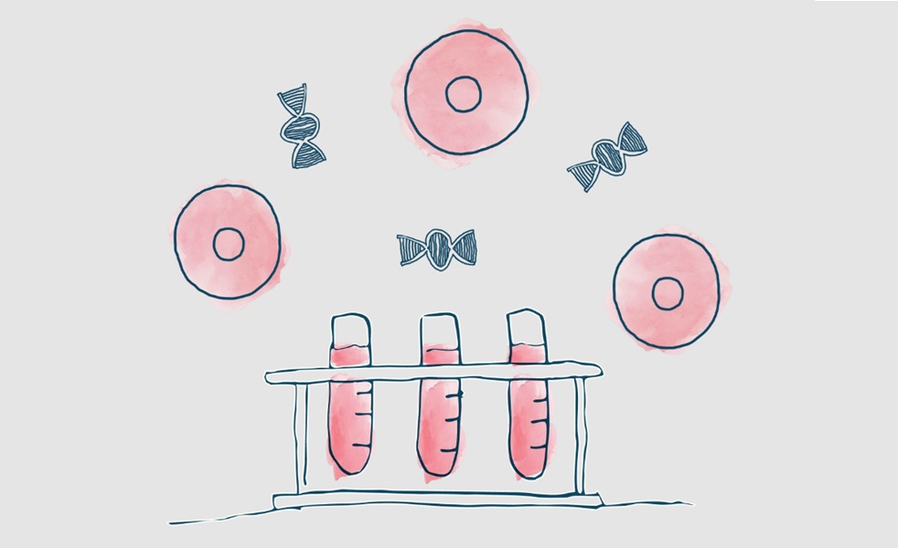 Image: AlloSure Kidney measures donor-derived cell-free DNA (dd-cfDNA) to assess graft injury, while AlloSure Plus combines the AlloSure result with additional clinical parameters. (Photo of CareDx)