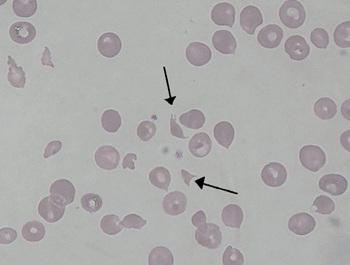 Image: Schistocytes in blood smear (Photo courtesy of Dr. Paulo H.O. Mourao).