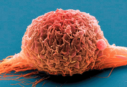 Image: Colored scanning electron micrograph (SEM) of a bladder cancer cell (Photo courtesy of Steve Gschmeissner / SPL). Image: Colored scanning electron micrograph (SEM) of a bladder cancer cell (Photo courtesy of Steve Gschmeissner / SPL).