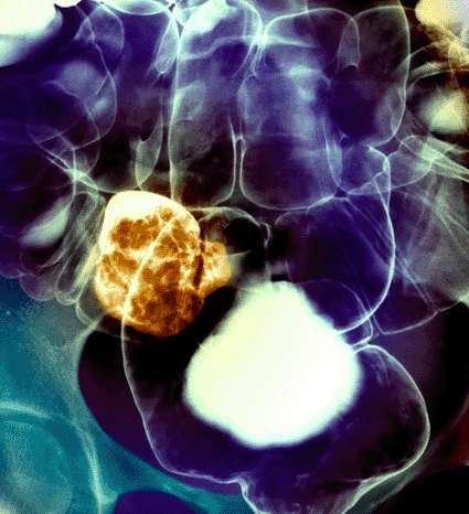 Image: Colored frontal x-ray of the large intestine of a patient with cancer of the sigmoid colon (Photo courtesy of Zephyr / SPL).