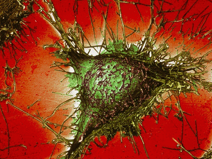 Image: Colored scanning electron micrograph (SEM) of a cell used in Alzheimer’s disease research that has genetically engineered to produce amyloid protein (Photo courtesy of Simon Fraser).