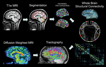 Image: Flowchart illustrates the steps of the connectivity analysis. MP-RAGE (magnetization-prepared rapid acquisition gradient echo) volumes are segmented into 83 region of interest (ROIs), which are further parcellated into 1,000 cortical and 15 subcortical ROIs. Whole-brain white matter tractography is performed after voxelwise tensor calculation, and the density of fibers that connect each pair of cortical ROIs is used to calculate structural connectivity. T1w = T1-weighted (Photo courtesy of RSNA).