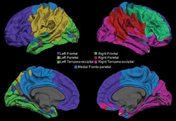 Image: Surface representation shows the gray-white matter junction of the seven modules that emerge by using the Newman spectral algorithm on an across-subject (both healthy subjects and patients with temporal lobe epilepsy [TLE]) average connectivity matrix (Photo courtesy of RSNA).