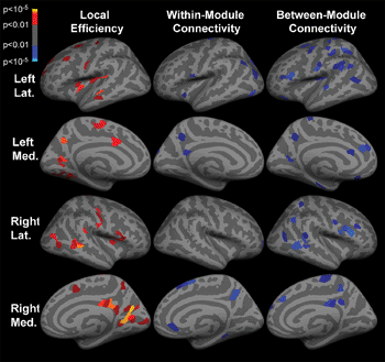 Image: Inflated cortical surface representations show the significant (p  the group of patients with TLE and healthy subjects. Warm colors (red, orange, and yellow) indicate increases in TLE, while cool colors (blue) indicate decreases. Within-module connectivity is within-module z score of degree, and between-module connectivity is participation coefficient. Light gray areas represent gyri, and dark gray areas represent sulci. Lat = lateral, Med = medial (Photo courtesy of RSNA).