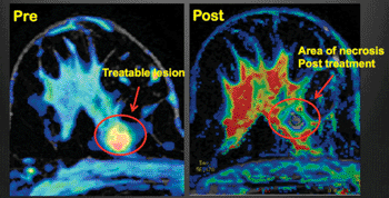 Image: PRE: Pretreatment transverse MR image obtained with perfusion technique shows an enhancing lesion of 1.2 cm (circled) in the upper quadrants of the right breast; the lesion shows with irregular margin and appears color-coded in red due to the washout pattern (malignancy). POST: Same MR image technique obtained post-treatment (10 days): Absence of enhancement was seen at perfusion color-coded image after noninvasive thermal ablation with MR-guided high-intensity focused ultrasound; the black hole stands for necrosis nicely demonstrating also the absence of residual tumor (Photo courtesy of RSNA).