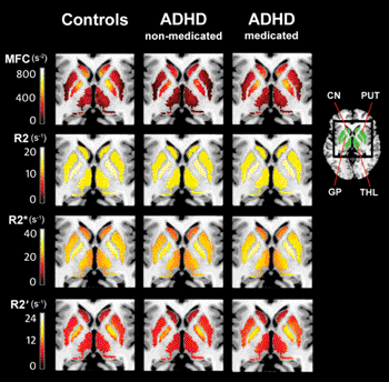 Image: Medication-naïve ADHD patients (ADHD-nonmedicated) have reduced striatal (putamen (PUT), caudate nucleus (CN)) and thalamic (THL) magnetic field correlation (MFC) measures of brain iron compared to controls and psychostimulant medicated ADHD patients (ADHD-medicated); Brain iron measures in PUT, CN, THL or globus pallidus (GP) did not differ between controls and psychostimulant medicated ADHD patients. These statistical significant differences are visible in the MFC group maps (top row) but not in conventional relaxation rate maps: R2 (second row), R2*(third row), and R2\' (bottom row) (Photo courtesy of RSNA).