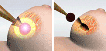 Image: Low energy radiation is delivered locally to the targeted tissue in the tumor bed, minimizing healthy tissue exposure to radiation (left). After 20-30 minutes of radiotherapy, the applicator is removed and the surgeon then closes the incision (right) (photo courtesy of Zeiss).