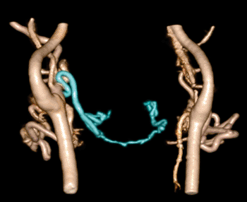 Image: CT angiography after face transplantation. Recipient’s left lingual artery was ligated, but the portion distal to the ligation (rectangular area) was still enhanced via blood flow from the contralateral side (arrow) (Photo courtesy of RSNA).