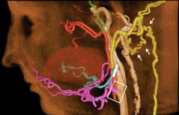Image: CT angiography after face transplantation. Donor’s external carotid artery (pink) was successfully anastomosed to the recipient’s vessel (rectangular area). Branches distal to the ligation (white line) receive blood flow from collateral vessels (arrows) (Photo courtesy of RSNA).
