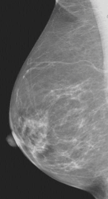 Image: Fatty breast tissue (Photo courtesy of RSNA).