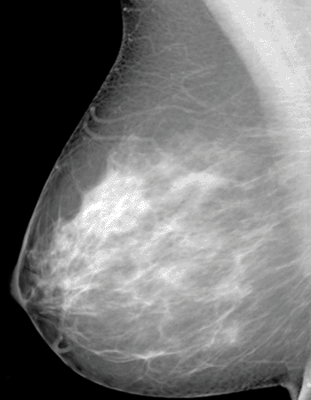 Image: Scattered density breast tissue (Photo courtesy of RSNA).