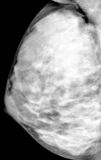 Image: Extremely dense breast tissue (Photo courtesy of RSNA).