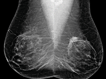 Image: Bilateral mediolateral oblique (MLO) views from screening mammography in a 53-year-old woman (Photo courtesy of RSNA).