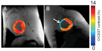 Image: Creatine CEST maps of healthy myocardium in a large animal (left). Eight week-old infarcted tissue, with noticeably less creatine (right). Arrow on right indicates infarcted region of heart tissue (Photo courtesy of Ravinder Reddy, PhD, Nature Medicine).