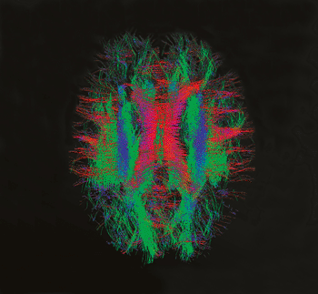Image: Diffusion MRI - Nerve fiber bundles in a newborn infant's brain. The red tracks are left-right fibers; the green tracks are anterior-posterior fibers; the blue tracks are superior-inferior (top-bottom) fibers (Photo courtesy of dHCP).
