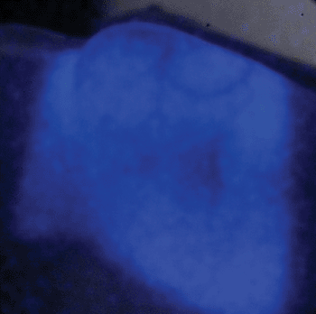 Image: A radiation beam treatment is visualized here in the first in human use of the technique. The blue represents the treatment area. As the dose fades, the treatment area becomes a dark gray shadow (Photo courtesy of Dartmouth University).