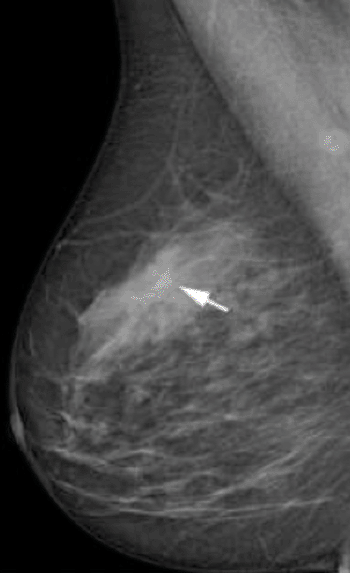 Image: Two-view screening mammograms obtained with the DR photon-counting system show a spiculated mass in the right upper quadrants (arrow). The diagnosis was invasive ductal carcinoma, 8 mm in diameter, as seen on the right mediolateral oblique image (Photo courtesy of Radiological Society of North America).