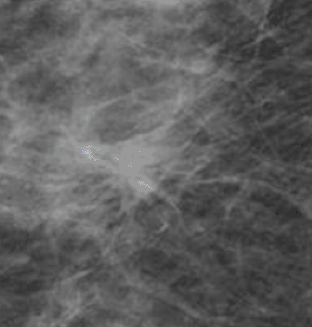 Image: Two-view screening mammograms obtained with the DR photon-counting system show a spiculated mass in the right upper quadrants. The diagnosis was invasive ductal carcinoma, 8 mm in diameter, as seen on the zoomed in craniocaudal image of the lesion (Photo courtesy of Radiological Society of North America).