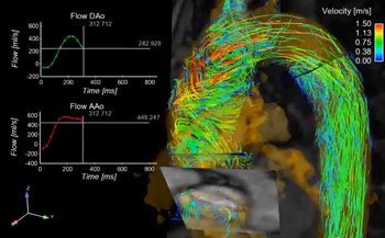 Image: 4D flow MRI used to enhance heart disease prediction capabilities (Photo courtesy of Northwestern University Feinberg School of Medicine).